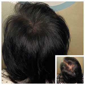 scalp micropigmentation soho nyc